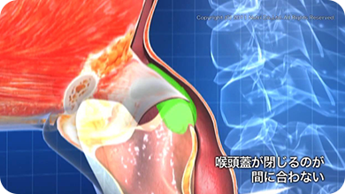 喉頭蓋が閉じるのが間に合わず、食べものを誤嚥する様子を示す