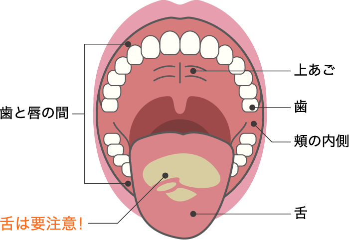 口の中で汚れが残りやすいところ（上あご、歯、頬の内側、舌、歯と唇の間）特に舌は要注意。